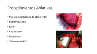 Procedimientos Ablativos
• Inyección percutánea de etanol (PEI)
• Radiofrecuencia
• Láser
• Crioablación
• Microondas
• “Electroporación”
 