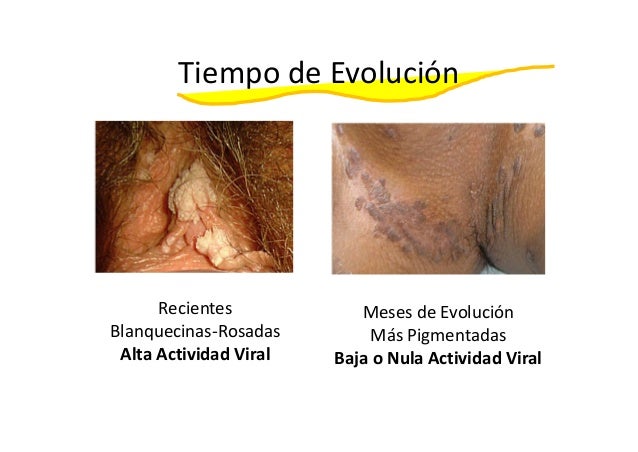 imiquimod verrugas precio