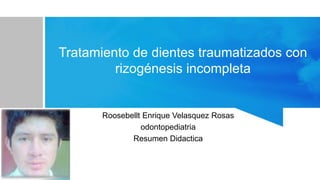 Tratamiento de dientes traumatizados con
rizogénesis incompleta
Roosebellt Enrique Velasquez Rosas
odontopediatria
Resumen Didactica
 