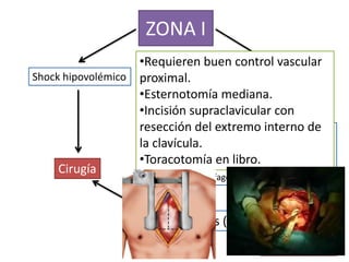 ZONA I
                   •Requieren buen control vascular
Shock hipovolémico proximal. Estabilidad hemodinámica
                                    Sospecha lesional
                   •Esternotomía mediana.
                   •Incisión supraclavicular con
                   resección del extremo interno de
                                Procedimientos diagnósticos:
                   la clavícula.Angiografía de vasos del cuello y
                                subclavios
                   •Toracotomía en libro.
                                Traqueobroncoscopia
     Cirugía
                                    Esofagograma y esofagoscopia



                              Lesiones (+)         Lesiones (-)
                                                   Observación
 