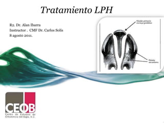 Tratamiento LPH
R2. Dr. Alan Ibarra
Instructor . CMF Dr. Carlos Solís
8 agost0 2011.
 