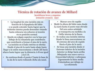 Técnica de rotación de avance de Millard
                                  hendiduras leves y angostas
                                   (rotación-avance). 1957.
     •   La longitud de esta incisión esta en              • Marcar arco de cupido
          función de la hipoplasia del labio         • Medir la altura del labio sano desde
       y se puede extender hasta lograr que la          La nariz hasta el punto mas elevado
    vertiente interna pueda descender rotando                 Del arco antes señalado
        hasta colocarse sin esfuerzo ni tensión          Y se transporta esa medida a la
                en su posición normal.                       Orilla interna de la fisura.
  • Queda un colgajo superior con la base por          • Se realiza una incisión interna
       debajo de la columnela que contribuira             Desde la línea mucocutanea en
    que contribuirá a formar el piso de la nariz.          El extremo del arco de cupido
   • La incisión en el lado externo se efectúa                Hacia el piso de la nariz.
     Desde el piso de la nariz hasta abajo hasta        • Se traza una incisión desde el
llegar a la unión mucocutanea y desde allí hacia          Extremo inferior de la incisión
afuera hasta lograr que la distancia A-B sea igual         Anterior se dirige hacia arriba
                      a la C-D.                            Dibujando una suave curva a
• Se continua desde el punto C hasta la base de          Concavidad inferior y sobrepasa
     la ala de la nariz rodeando dicha ala nasal.           Ligeramente la línea media
                                                            Colocándose por debajo de
                                                                    La columnela
 