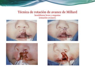 Técnica de rotación de avance de Millard
           hendiduras leves y angostas
               (rotación-avance).
 