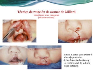 Técnica de rotación de avance de Millard
           hendiduras leves y angostas
               (rotación-avance).




                                         Sutura 6 ceros para evitar el
                                         Marcaje posterior
                                         Se ha devuelto la altura y
                                         La continuidad de la línea
                                         Muco cutánea .
 
