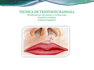 TECNICA DE TENNYSON/RANDALL
    Modificada por Hernández y Verdeja 1964
              hendidura mediana
              (colgajo triangular).
 