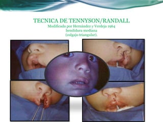 TECNICA DE TENNYSON/RANDALL
    Modificada por Hernández y Verdeja 1964
              hendidura mediana
              (colgajo triangular).
 