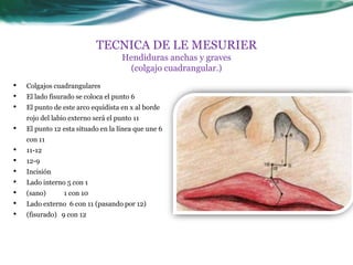 TECNICA DE LE MESURIER
                                     Hendiduras anchas y graves
                                      (colgajo cuadrangular.)
•   Colgajos cuadrangulares
•   El lado fisurado se coloca el punto 6
•   El punto de este arco equidista en x al borde
    rojo del labio externo será el punto 11
•   El punto 12 esta situado en la línea que une 6
    con 11
•   11-12
•   12-9
•   Incisión
•   Lado interno 5 con 1
•   (sano)      1 con 10
•   Lado externo 6 con 11 (pasando por 12)
•   (fisurado) 9 con 12
 