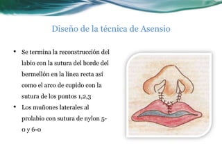 Diseño de la técnica de Asensio

•   Se termina la reconstrucción del
    labio con la sutura del borde del
    bermellón en la línea recta así
    como el arco de cupido con la
    sutura de los puntos 1,2,3
•   Los muñones laterales al
    prolabio con sutura de nylon 5-
    0 y 6-0
 