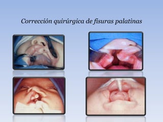 Corrección quirúrgica de fisuras palatinas
 