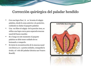 Corrección quirúrgica del paladar hendido

•   Con una legra fina 7 A se levanta el colgajo
    palatino, desde la zona anterior a la posterior,
    cuidando no dañar el paquete palatino
•   Una vez libre el colgajo de la porción ósea, se
    utiliza una legra curva para separarla mucosa
    nasal del hueso maxilar.
•   Se e longa en este momento el paquete
    palatino se debe tener cuidado de no
    lesionarlo o romperlo.
•   Se inicia la reconstrucción de la mucosa nasal
    con dexon 3-0 y puntos aislados, enseguida la
    úvula y el velo del paladar (técnica san Venero
    Roselli)
 