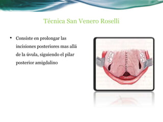 Técnica San Venero Roselli

•   Consiste en prolongar las
    incisiones posteriores mas allá
    de la úvula, siguiendo el pilar
    posterior amigdalino
 