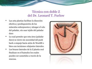 Técnica con doble Z
                          del Dr. Leonard T. Furlow
•   Las zeta plastias facilitan la disección
    efectiva y predisposición de los
    músculos sobrepuestos y alongar el velo
    del paladar, sin usar tejido del paladar
    duro
•   Lo cual permite que esta área (paladar
    duro) se cierre sin necesidad del push
    back o empuje hacia atrás de Wardill o
    bien con incisiones relajantes laterales.
•   Los brazos laterales de la Z plastia oral
    finalizan en el hamulos los cuales
    pueden ser sometidos a través de la
    mucosa.
 