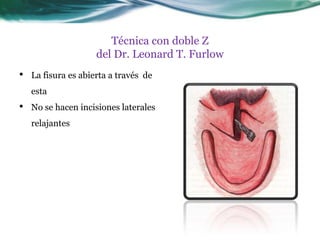 Técnica con doble Z
                     del Dr. Leonard T. Furlow
•   La fisura es abierta a través de
    esta
•   No se hacen incisiones laterales
    relajantes
 