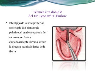 Técnica con doble Z
                     del Dr. Leonard T. Furlow

•   El colgajo de la base posterior
    es elevado con el musculo
    palatino, el cual es separado de
    su inserción ósea y
    cuidadosamente elevado desde
    la mucosa nasal a lo largo de la
    fisura.
 