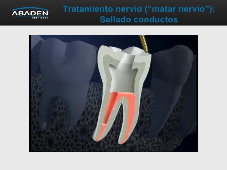 Tratamiento del nervio