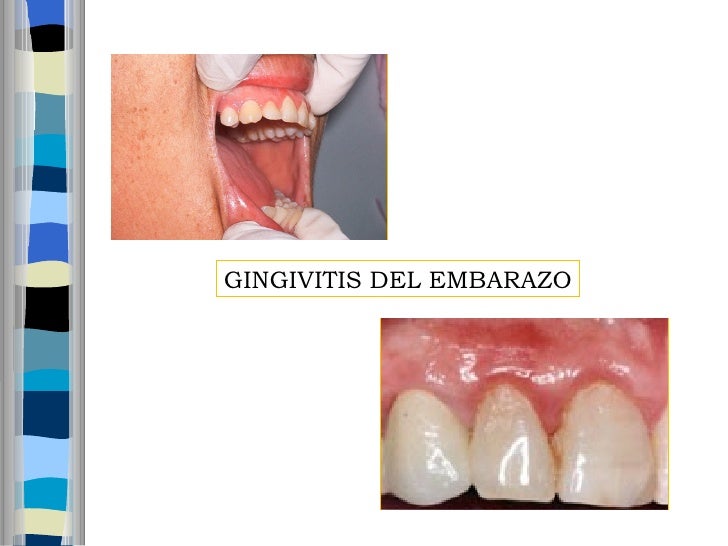 Tratamiento Odontologico De Las Gestantes