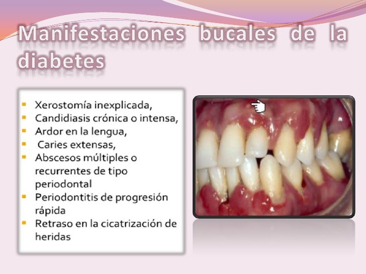 Tratamiento Odontologico En Pacientes Con Diabetes Mellitus Tratamiento Odontologico En Pacientes Con Diabetes Mellitus