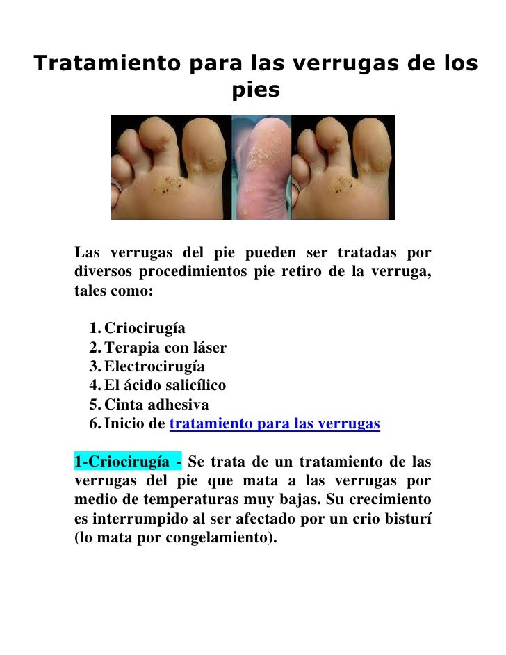 Como escoger las medias medicinales a varikoze