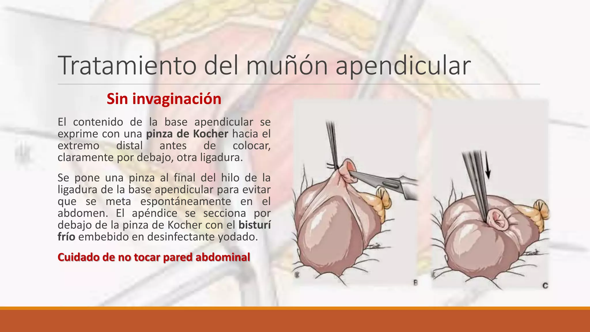 Tratamiento quirúrgico de apendicitis aguda | PPTX