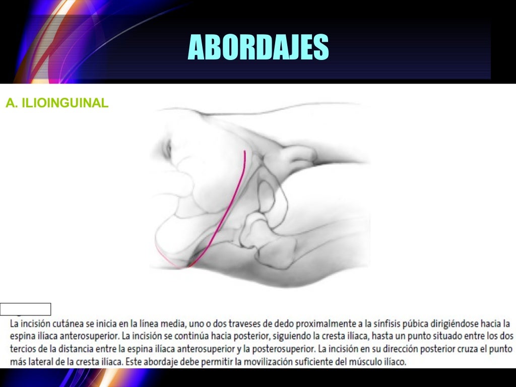 Tratamiento quirúrgico de las fracturas de acetábulo