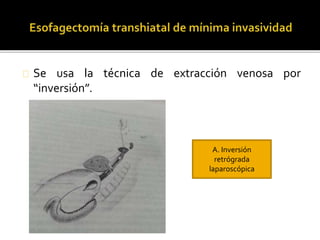 Se usa la técnica de extracción venosa por 
“inversión”. 
A. Inversión 
retrógrada 
laparoscópica 
 