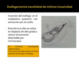 Inversión del esófago en el 
mediastino posterior con 
extracción por el cuello. 
Esta técnica sólo se utiliza 
en displasia de alto grado y 
cáncer únicamente 
detectable por 
microscopia. 
B. Inversión anterógrada 
laparoscópica. 
Una sutura de seda sostiene el túnel 
después de extirpar el esófago 
 
