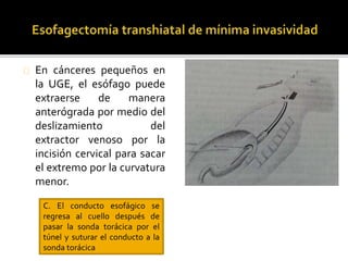 En cánceres pequeños en 
la UGE, el esófago puede 
extraerse de manera 
anterógrada por medio del 
deslizamiento del 
extractor venoso por la 
incisión cervical para sacar 
el extremo por la curvatura 
menor. 
C. El conducto esofágico se 
regresa al cuello después de 
pasar la sonda torácica por el 
túnel y suturar el conducto a la 
sonda torácica 
 