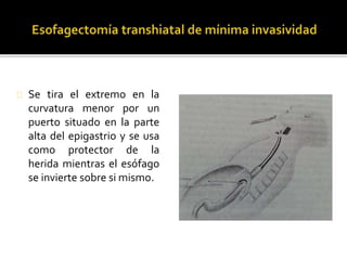 Se tira el extremo en la 
curvatura menor por un 
puerto situado en la parte 
alta del epigastrio y se usa 
como protector de la 
herida mientras el esófago 
se invierte sobre si mismo. 
 