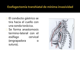 El conducto gástrico se 
tira hacia el cuello con 
una sonda torácica. 
Se forma anastomosis 
termino-lateral con el 
esófago cervical 
(engrapadora o 
sutura). 
 