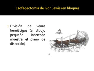 División de venas 
hemiácigos (el dibujo 
pequeño insertado 
muestra el plano de 
disección) 
 