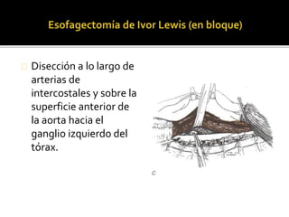 Disección a lo largo de 
arterias de 
intercostales y sobre la 
superficie anterior de 
la aorta hacia el 
ganglio izquierdo del 
tórax. 
 