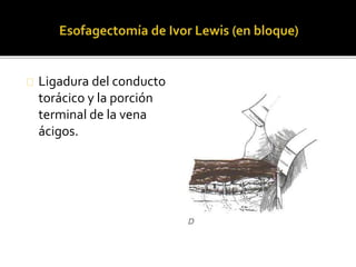 Ligadura del conducto 
torácico y la porción 
terminal de la vena 
ácigos. 
 