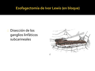 Disección de los 
ganglios linfáticos 
subcarineales 
 
