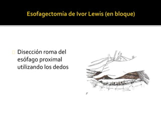 Disección roma del 
esófago proximal 
utilizando los dedos 
 