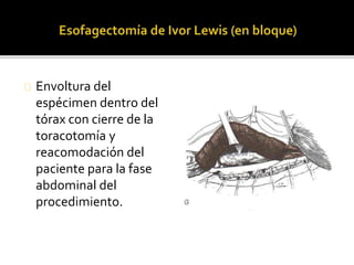 Envoltura del 
espécimen dentro del 
tórax con cierre de la 
toracotomía y 
reacomodación del 
paciente para la fase 
abdominal del 
procedimiento. 
 