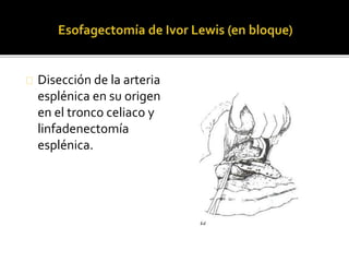Disección de la arteria 
esplénica en su origen 
en el tronco celiaco y 
linfadenectomía 
esplénica. 
 