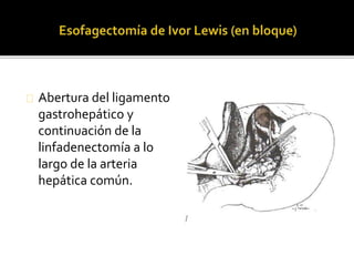 Abertura del ligamento 
gastrohepático y 
continuación de la 
linfadenectomía a lo 
largo de la arteria 
hepática común. 
 