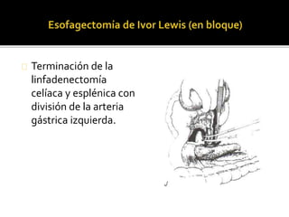 Terminación de la 
linfadenectomía 
celíaca y esplénica con 
división de la arteria 
gástrica izquierda. 
 