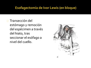 Transección del 
estómago y remoción 
del espécimen a través 
del hiato, tras 
seccionar el esófago a 
nivel del cuello. 
 