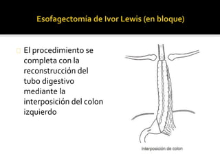 El procedimiento se 
completa con la 
reconstrucción del 
tubo digestivo 
mediante la 
interposición del colon 
izquierdo 
 