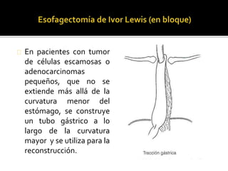 En pacientes con tumor 
de células escamosas o 
adenocarcinomas 
pequeños, que no se 
extiende más allá de la 
curvatura menor del 
estómago, se construye 
un tubo gástrico a lo 
largo de la curvatura 
mayor y se utiliza para la 
reconstrucción. 
 