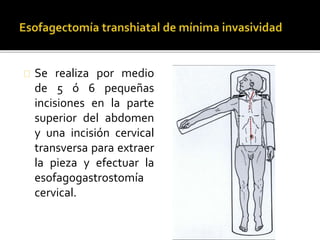 Se realiza por medio 
de 5 ó 6 pequeñas 
incisiones en la parte 
superior del abdomen 
y una incisión cervical 
transversa para extraer 
la pieza y efectuar la 
esofagogastrostomía 
cervical. 
 