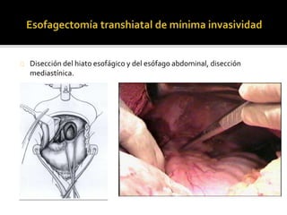 Disección del hiato esofágico y del esófago abdominal, disección 
mediastínica. 
 