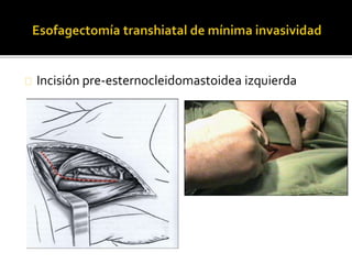 Incisión pre-esternocleidomastoidea izquierda 
 