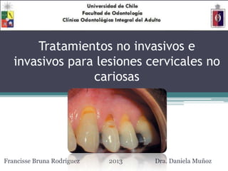 Tratamientos no invasivos e
invasivos para lesiones cervicales no
cariosas
Francisse Bruna Rodríguez 2013 Dra. Daniela Muñoz
 