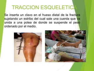 TRACCION ESQUELETICA
Se inserta un clavo en el hueso distal de la fractura
sujetando un estribo del cual sale una cuerda que va
unida a una polea de donde se suspende el peso
ordenado por el medio.

 