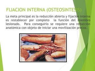 FIJACION INTERNA (OSTEOSINTESIS)
La meta principal es la reducción abierta y fijación interna
es restablecer por completo la función del miembro
lesionado. Para conseguirlo se requiere una reducción
anatómica con objeto de iniciar una movilización precoz.

 