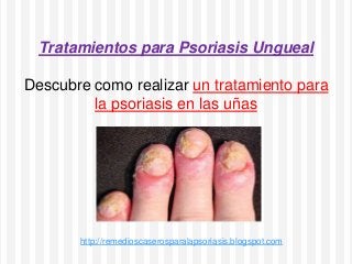 Tratamientos para Psoriasis Ungueal
Descubre como realizar un tratamiento para
la psoriasis en las uñas
http://remedioscaserosparalapsoriasis.blogspot.com
 
