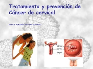 Tratamiento y prevención de
Cáncer de cervical
RAMOS ALMIRÓN VÍCTOR ANTONIO
cervix
vagina
cáncer
 