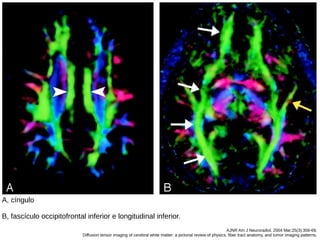 AJNR Am J Neuroradiol. 2004 Mar;25(3):356-69.
Diffusion tensor imaging of cerebral white matter: a pictorial review of physics, fiber tract anatomy, and tumor imaging patterns.
A, cíngulo
B, fascículo occipitofrontal inferior e longitudinal inferior.
 
